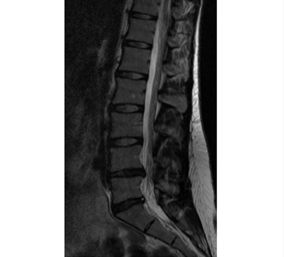 Hình 2: MRI cột sống: thoái hóa đĩa đệm L4-5 với một chỗ phình trên đĩa và đĩa L5S1 với một khu vực có độ nhạy cảm cao Từ thông tin thu thập của Bác sĩ N. Quiraishi