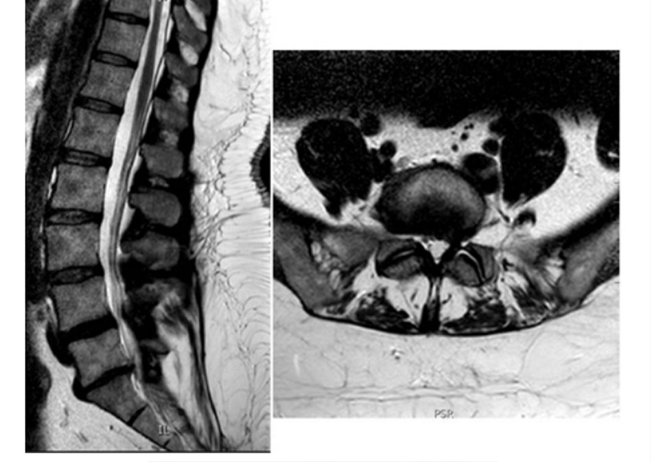 Hình 3: MRI có trọng số T2 cột sống: mặt cắt đứng dọc (bên trái) chp thấy thoái hóa đĩa đệm; mặt cắt ngang thân (bên phải) cho thấy hẹp foramen L5S1 bên trái Từ thông tin thu thập của Bác sĩ N. Quiraishi