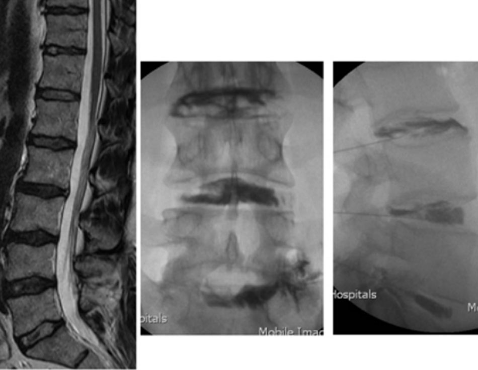 Hình 5: Chụp đĩa đệm: bệnh nhân đến khám với chứng đau lưng và đau chân phải không đáp ứng với thử nghiệm điều trị bảo tồn. MRI (trái, hình ảnh dọc giữa thiên về T2) cho thấy nhiều đĩa đệm bị thoái hóa kèm theo suy giảm lượng nước bình thường, giảm tín hiệu, và mất chuyển đổi nhân-vành khăn, với chiều cao đĩa đệm bình thường. Chụp đĩa đệm 3 mức tại L3-4, L4-5, và L5S1 (giữa, x-quang trước sau; phải, x-quang bên) cho thấy chỗ tiêm áp lực thấp với các vết rách vành khăn thoái hóa ở cả 3 mức, với 5/5 cơn đau tái tạo tại L5S1; 3/5 tại L4-5; và 0/5 tại L3-4 Từ thông tin thu thập của Bác sĩ N. Quiraishi