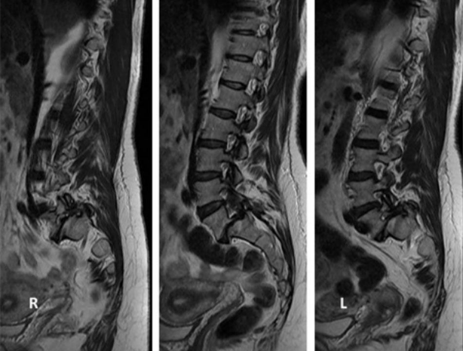 Hình 7: Chuỗi MRI T2 dọc giữa tiền phẫu thuật Từ thông tin thu thập của Bác sĩ N. Quiraishi