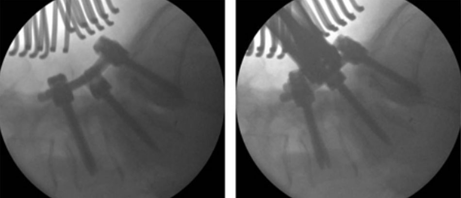 Hình 8: Các hình ảnh trong khi phẫu thuật cho thấy giảm biến dạng từ từ: hợp nhất L4 vào S1 sử dụng dụng cụ, hợp nhất qua foramen tại L5S1 và giải nén L5 hai bên Từ thông tin thu thập của Bác sĩ N. Quiraishi