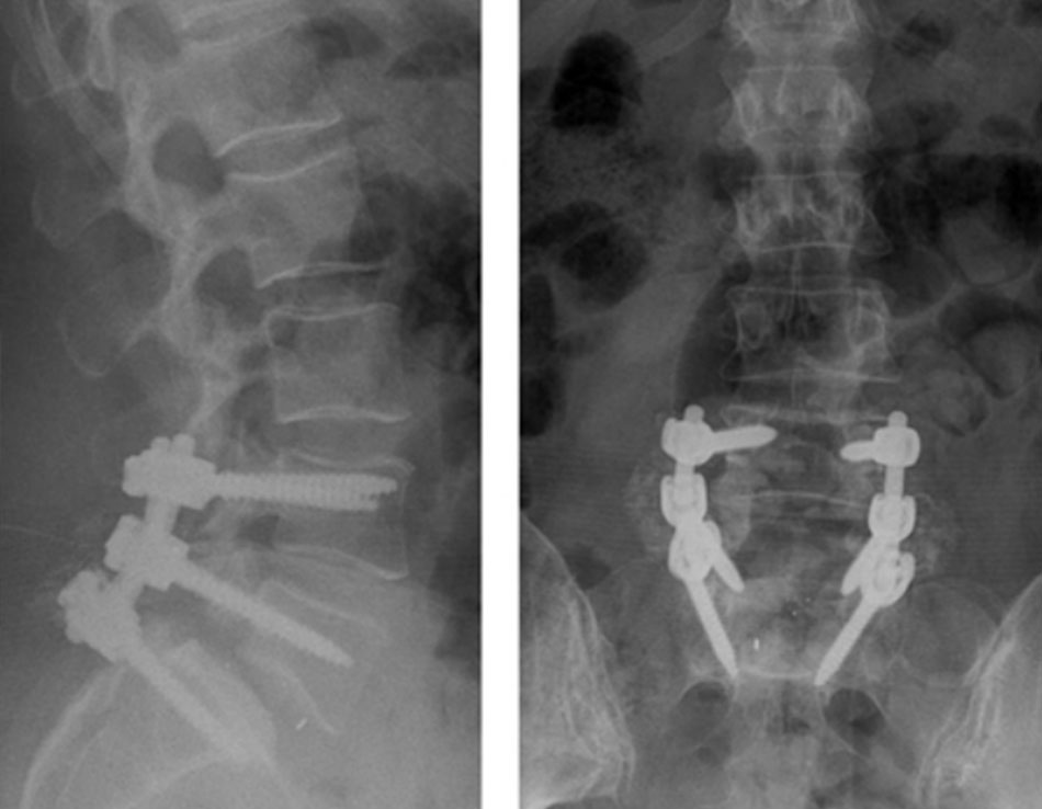 Hình 9: Chụp x-quang sau phẫu thuật Từ thông tin thu thập của Bác sĩ N. Quiraishi