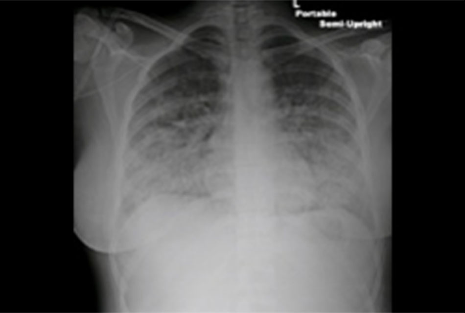 Hình 2: XQ ngực thẳng phù phổi cấp tính cho thấy tăng các đường phế nang, dịch trong các rãnh liên thùy bé và làm tù các góc sườn hoành Từ các bộ sưu tập riêng của David W. Yusuf, MBBS, MRCPI, và Daniel Lenihan, MD