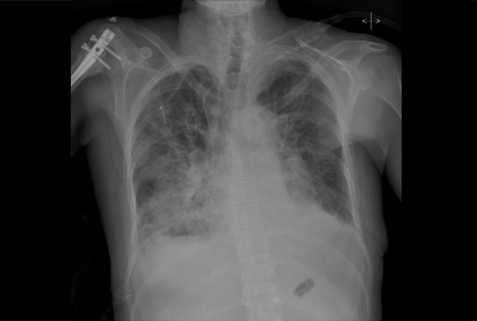 Hình 3: XQ ngực thẳng phù phổi cấp tính cho thấy tăng các đường phế nang, và tràn dịch màng phổi hai bên Từ các bộ sưu tập riêng của David W. Yusuf, MBBS, MRCPI, và Daniel Lenihan, MD
