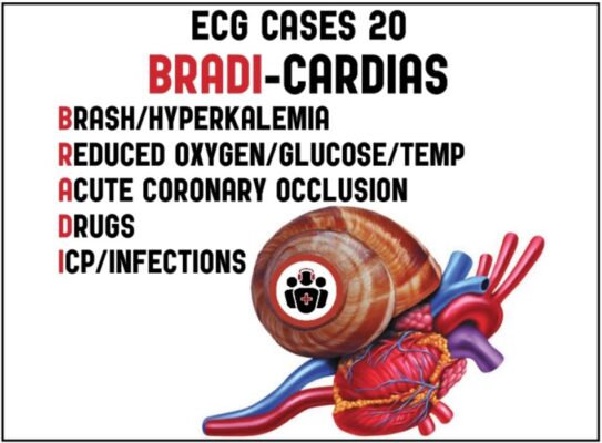 Rối loạn nhịp chậm tại cấp cứu: Các case ECG và thuật ngữ nhớ BRADI