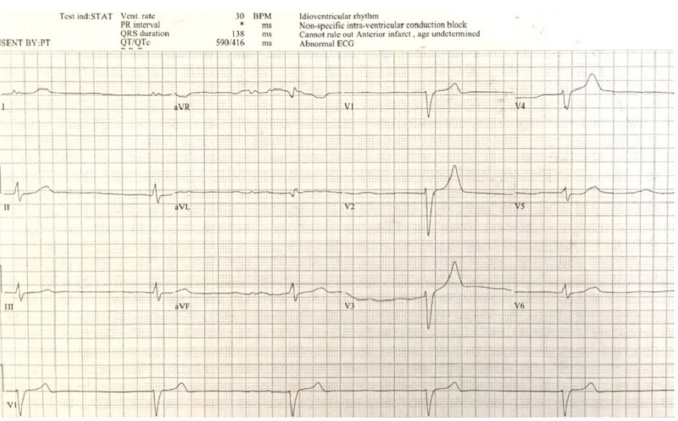 Case 10: Nhịp chậm bộ nối với QRS giãn rộng, thứ phát do tăng kali máu