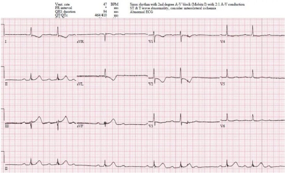 Case 2: Bệnh nhân 80 tuổi, có tiền sử tăng huyết áp, đang dùng amlodipine, bị đau ngực cấp tính và nôn. HR 50, BP 140/70