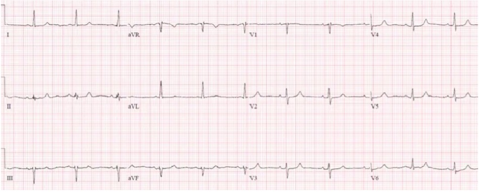 Case 4: Bệnh nhân 90 tuổi, có tiền sử tăng huyết áp, đang dùng atenolol, lú lẫn và yếu/chóng mặt. HR 35, BP 80/50. ECG cũ trước đây, sau đó là ECG mới