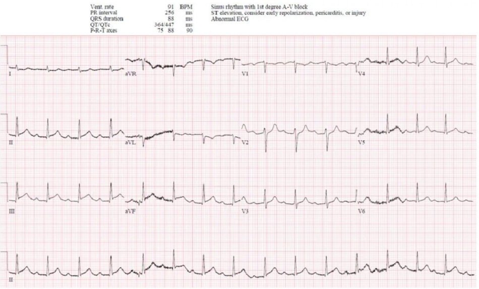 Case 5: Bệnh nhân 50 tuổi bị rung thất ngừng tim và ROSC, HR 40, HA 60/40, bắt đầu truyền epinephrine. Chuỗi ECG nối tiếp