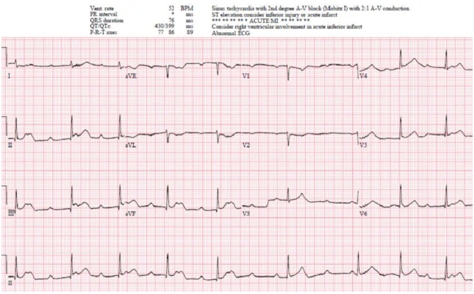 Case 5: Bệnh nhân 50 tuổi bị rung thất ngừng tim và ROSC, HR 40, HA 60/40, bắt đầu truyền epinephrine. Chuỗi ECG nối tiếp