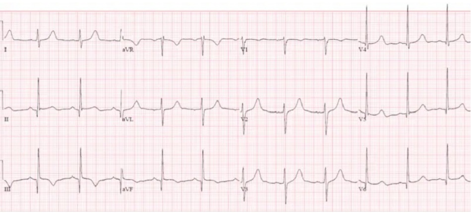 Case 5: Bệnh nhân 50 tuổi bị rung thất ngừng tim và ROSC, HR 40, HA 60/40, bắt đầu truyền pinephrine. Chuỗi ECG nối tiếp
