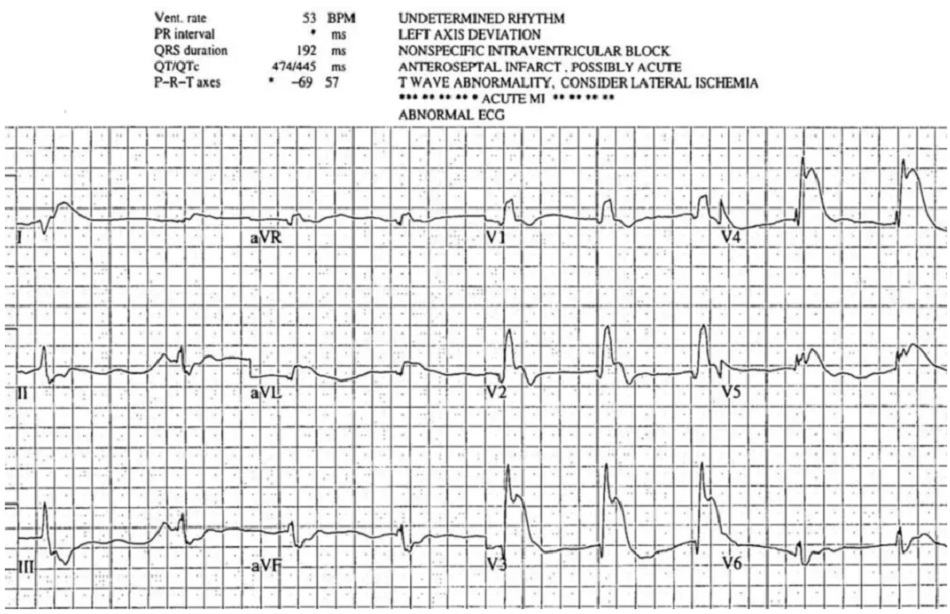 Case 9: Bệnh nhân 70 tuổi bị rung thất ngừng tim và ROSC, HR 50 BP 90/50