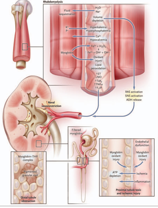 Hình 2. Cơ chế bệnh sinh của AKI do tiêu cơ vân