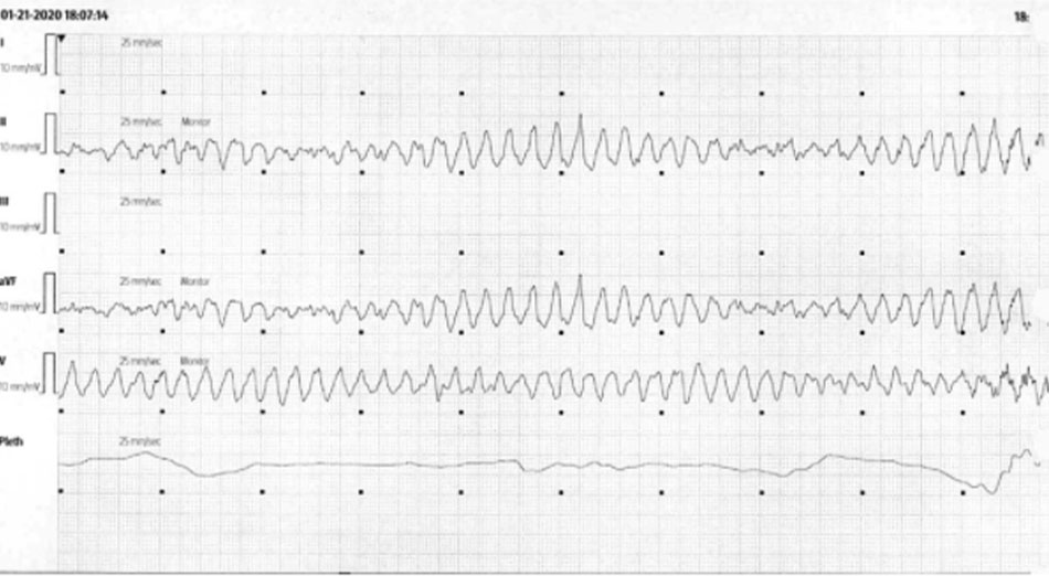 Hình 3: Monitoring của bệnh nhân Hình ảnh thời điểm bệnh nhân xuất hiện TdP cuối cùng cần khử rung tim. Bệnh nhân phát triển một vài đợt TdP ngắn không kéo dài trong 20 phút trước đợt TdP này.