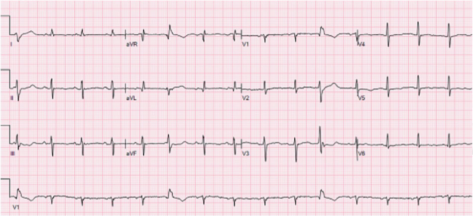 Hình 4: EKG 12 đạo trình sau khi đặt PPM EKG 12 chuyển đạo cuối cùng này cho thấy sự khỏi hoàn toàn của khoảng QT còn 406 ms sau khi đặt PPM với thiết lập tần số tim cao hơn.