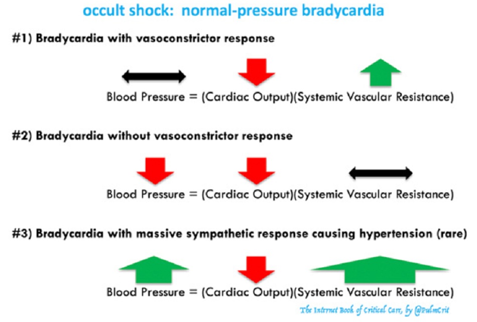 Hình 2: Tổng quan về rối loạn nhịp tim chậm