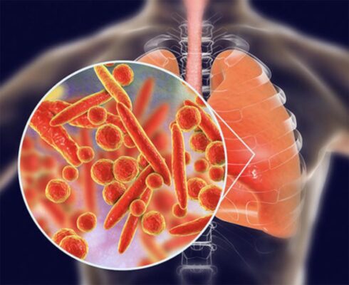 Sử dụng kháng sinh trong điều trị viêm phổi do vi khuẩn không điển hình