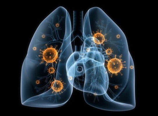 Viêm phổi cộng đồng: Các chiến lược phân loại và điều trị