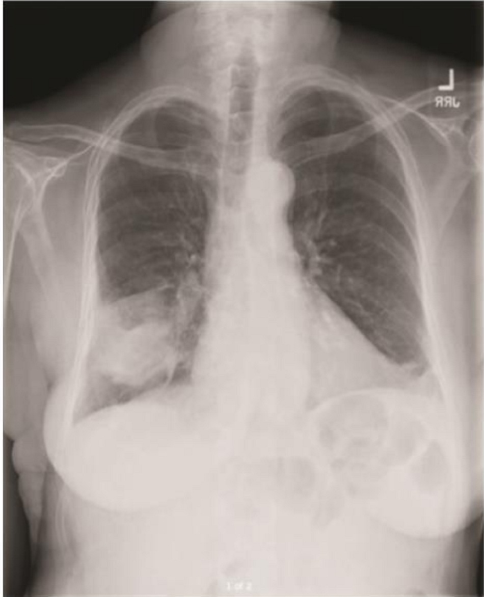 Hình 1. Viêm phổi thùy khu trú