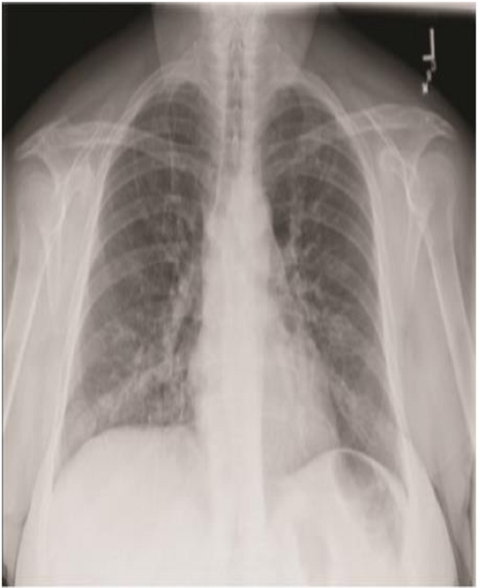 Hình 2. Viêm phổi mô kẽ lan tỏa