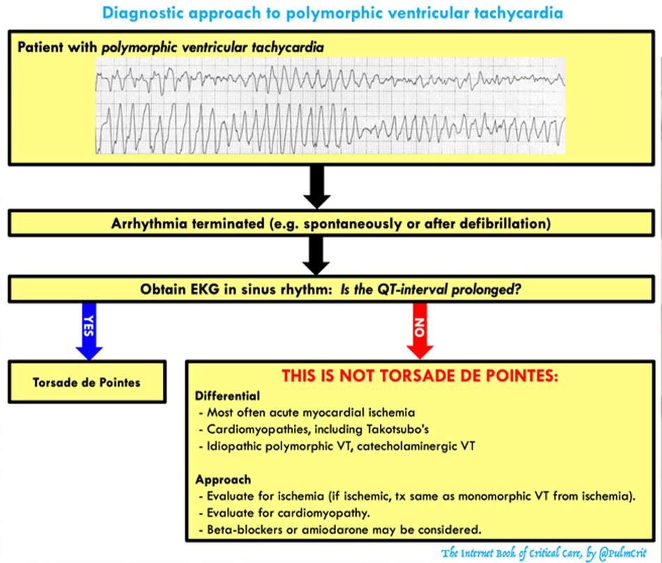 Diagnostic approach to polymorphic ventricular tachycardia