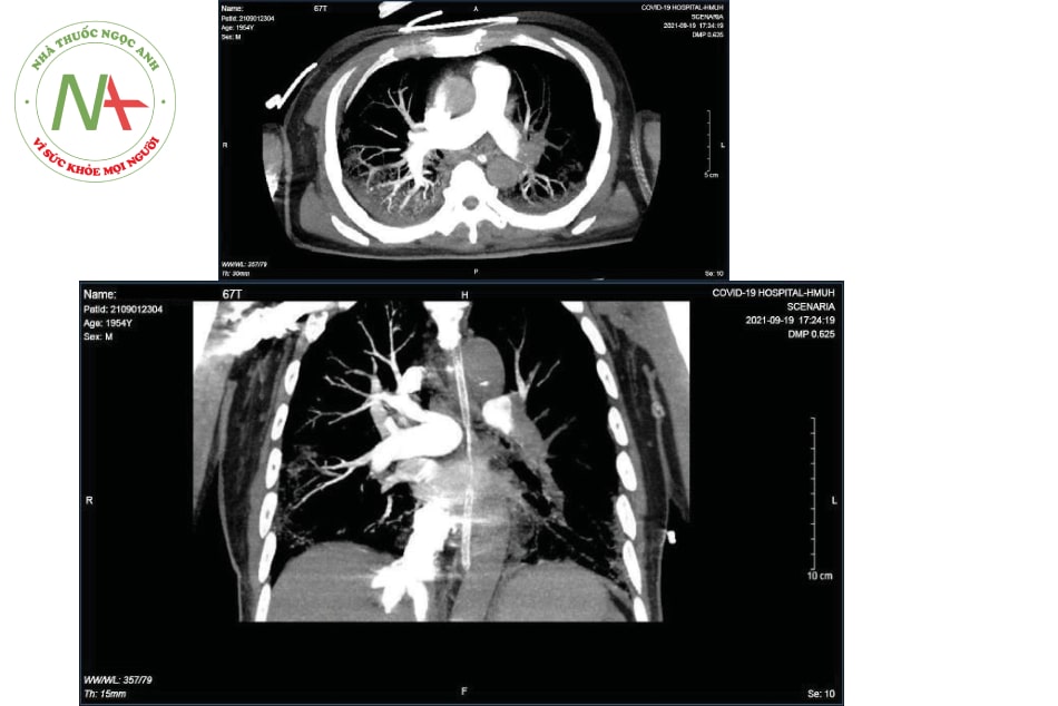 Hình 16.6. Huyết khối gây tắc hoàn toàn động mạch phổi trái ở bệnh nhân COVID-19