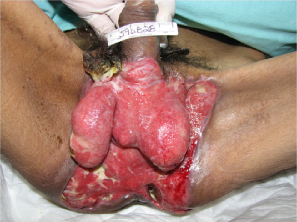 Hình 1: Viêm cân mạc hoại tử týp I ảnh hưởng đến vùng tầng sinh môn và cơ quan sinh dục; hình ảnh được chụp sau phẫu thuật cắt lọc mở rộng