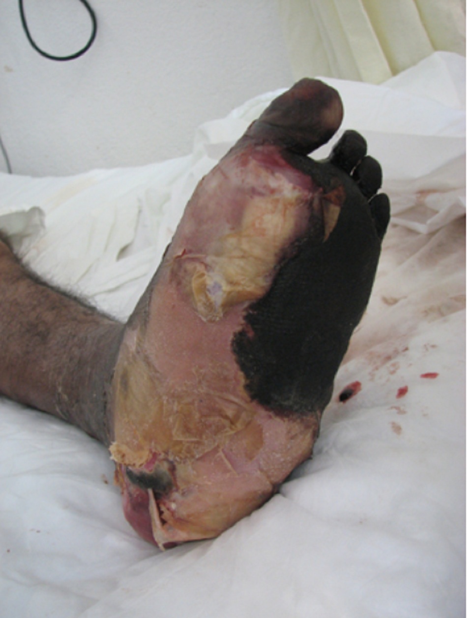 Hình 2: Hình thành eschar và phỏng nước kèm phù nề nhận thấy rõ ở bệnh nhân đái tháo đường xuất hiện hoại thư sinh hơi sau khi bị chấn thương chân