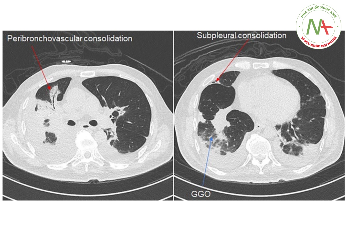 Hình 2. Chụp cắt lớp vi tính độ phân giải cao lồng ngực của ca lâm sàng thứ 2, vào ngày thứ 28 COVID-19 cho thấy đám đông đặc quanh phế quản-mạch máu và dưới màng phổi hai bên với hình ảnh kính mờ rải rác.