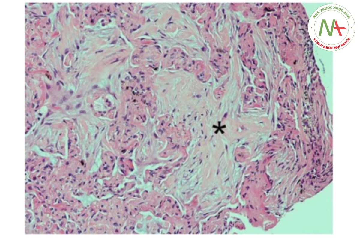 Hình 3. Một mẫu lát cắt bệnh phẩm lấy từ phế quản thùy trên bên phải qua sinh thiết xuyên phế quản trong ca lâm sàng thứ 2 cho chẩn đoán xác định viêm phổi tổ chức hóa với các đám nguyên bào sợi (dấu hoa thị) trong phế nang.