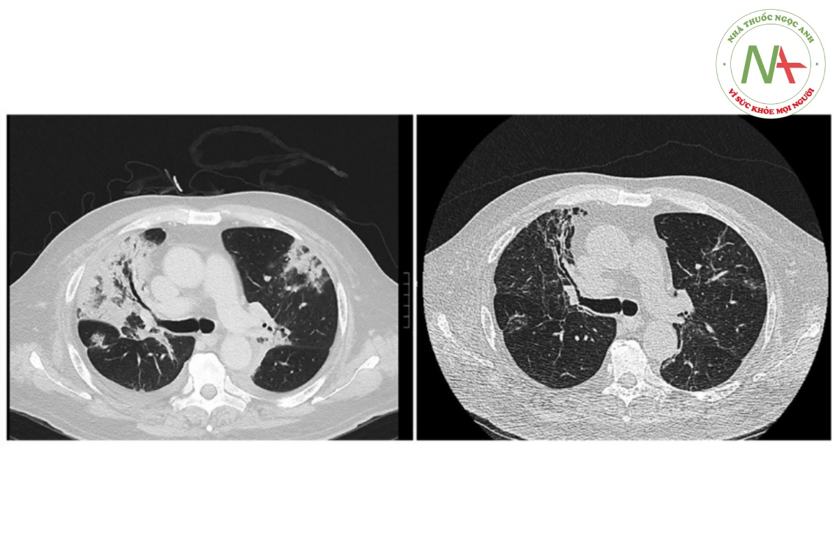 Hình 4. Cắt lớp vi tính ngực của ca lâm sàng thứ 3 trước (trái) và sau (phải) sau 166 ngày dùng prednisolone đường uống điều trị viêm phổi tổ chức hóa hậu COVID-19.