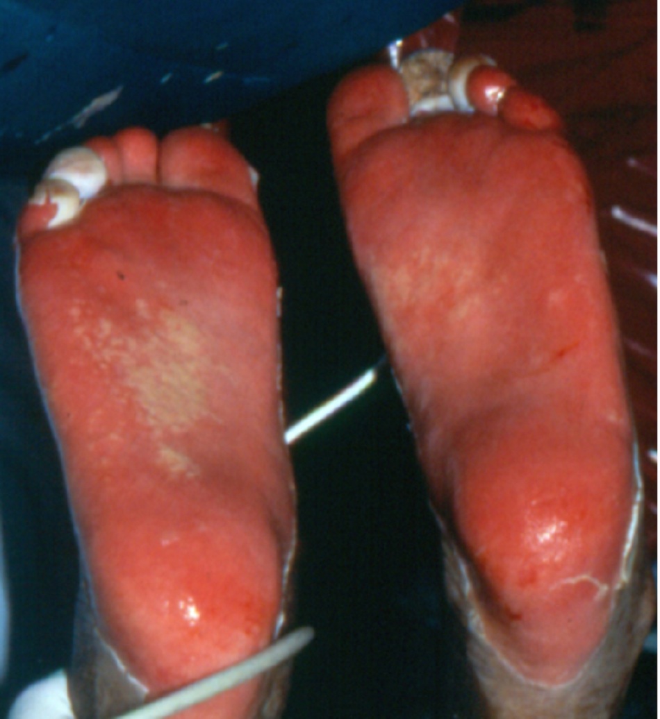 Hình 1: Hội chứng Stevens-Johnson: mất biểu bì ở lòng bàn chân