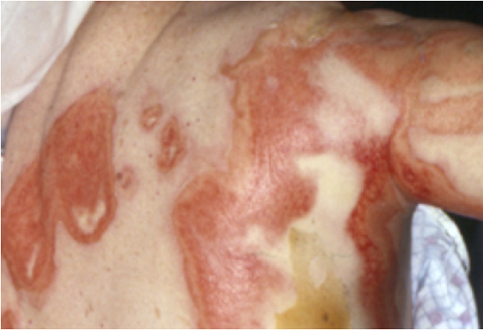 Hình 4: Hội chứng Stevens-Johnson: các tổn thương dạng bia bắn và mất biểu bì