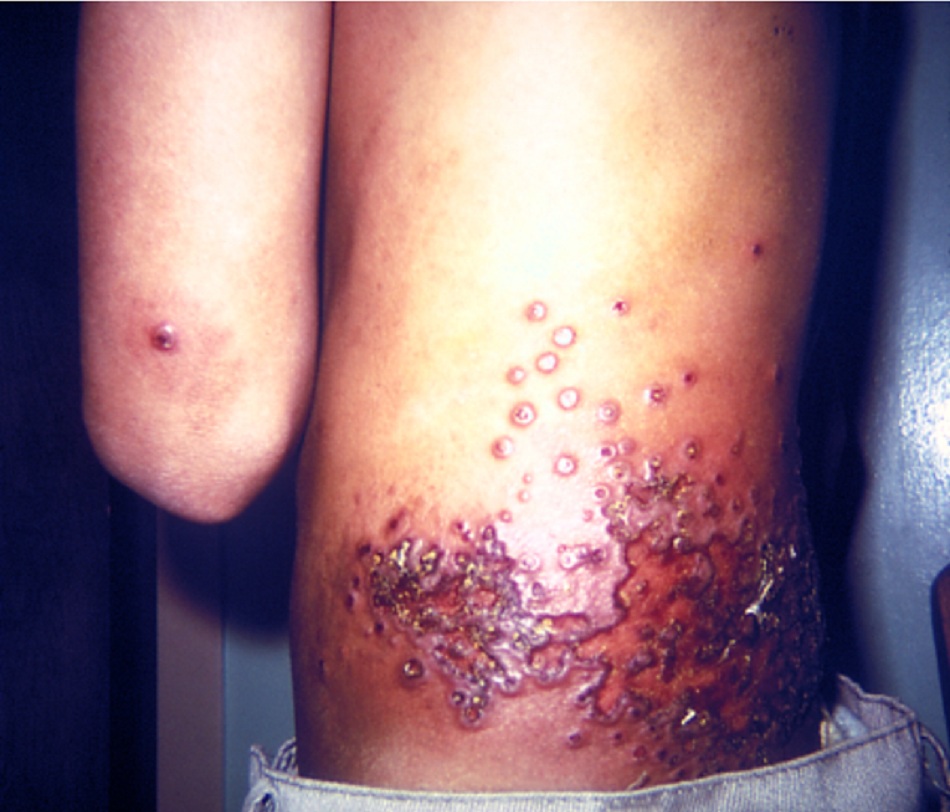 Hình 2: Các tổn thương da (eczema) sau tiêm vắc-xin đậu mùa trên cơ thể của người nhận 
