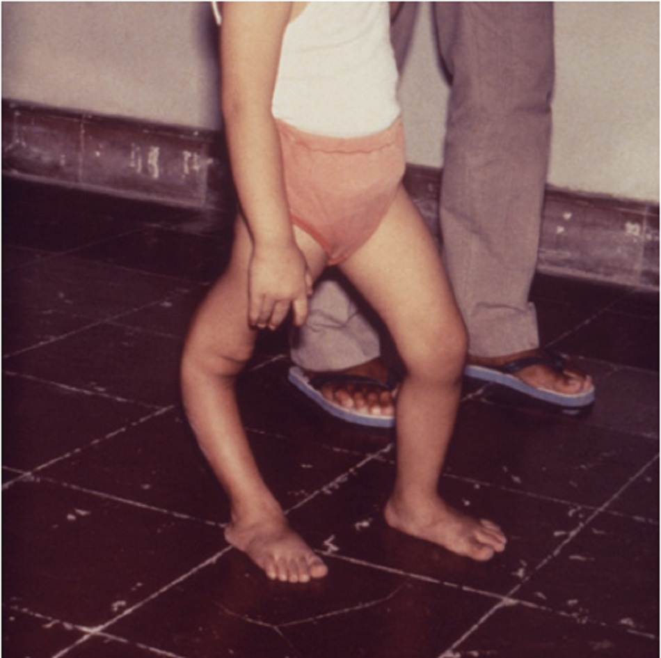 Hình 4: Trẻ biểu hiện dị dạng chân phải do bệnh bại liệt 