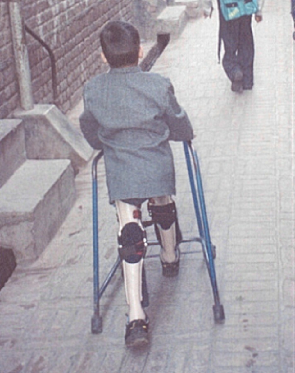 Hình 5: Một bé trai bị bại liệt đi lại với nẹp chân hai bên: Peshawar, Pakistan