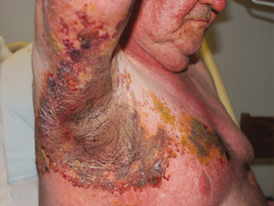 Hình 1: Herpes zoster nặng ở bệnh nhân suy giảm miễn dịch có liên quan đến khoanh da T1 và T2