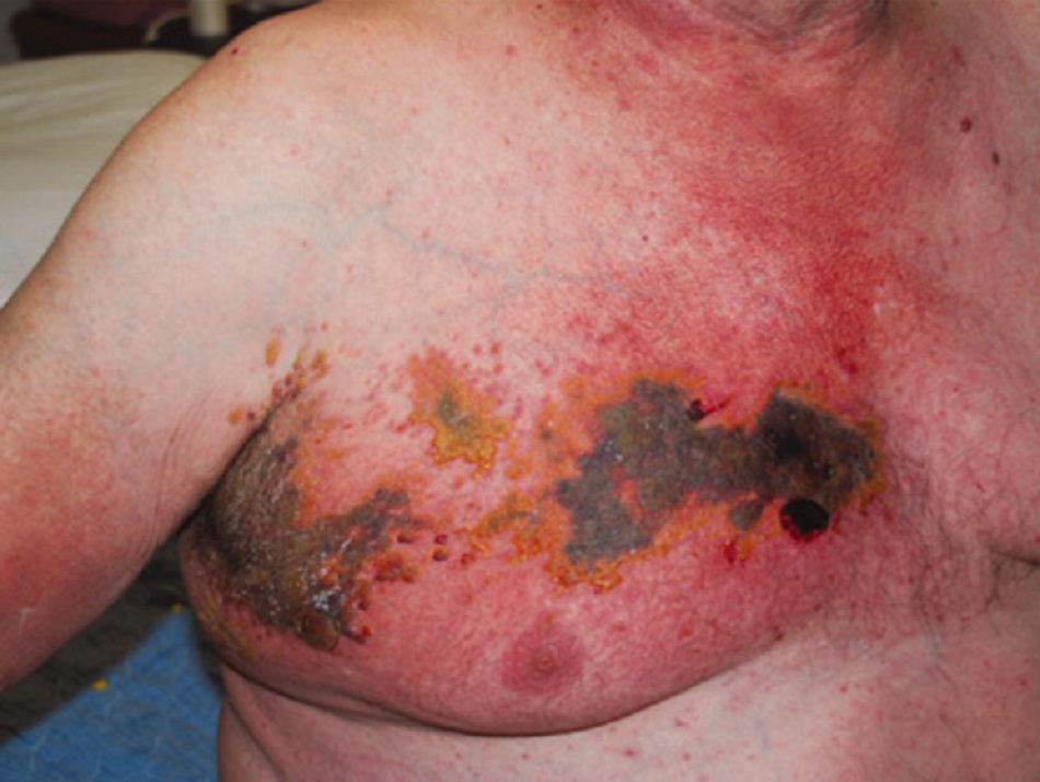 Hình 2: Herpes zoster nặng ở bệnh nhân suy giảm miễn dịch có liên quan đến khoanh da T1 và T2