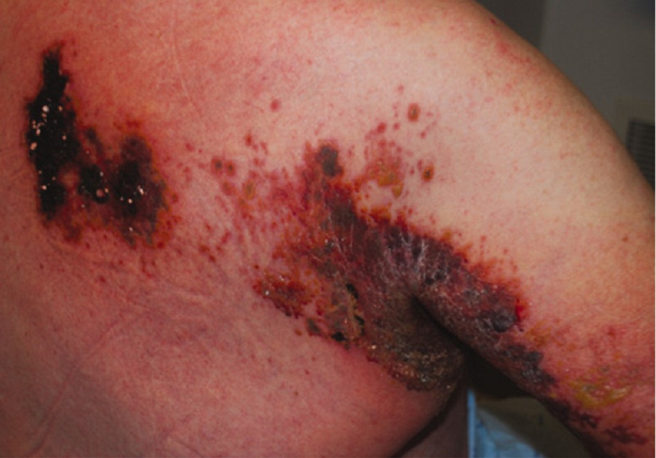 Hình 3: Herpes zoster nặng ở bệnh nhân suy giảm miễn dịch cho thấy nhiều mụn nước mọc thành đám, một vài mụn mủ, và lớp vảy dính màu đen nhạt lan rộng, với tình trạng bong tróc da bên dưới được ghi nhận