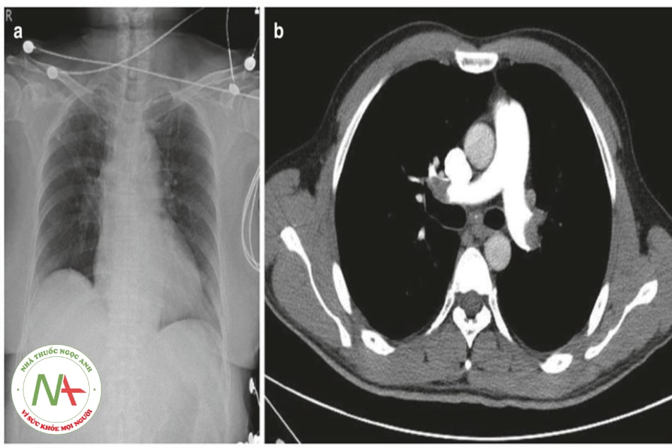 Hình 9.6. (a) Chụp Xquang ngực không cung cấp bất kỳ thông tin chẩn đoán nào trong thuyên tắc huyết khối phổi ở hầu hết các trường hợp. (b) Động mạch phổi chính hai bên bị tắc do huyết khối khi chụp CT ngực có cản quang