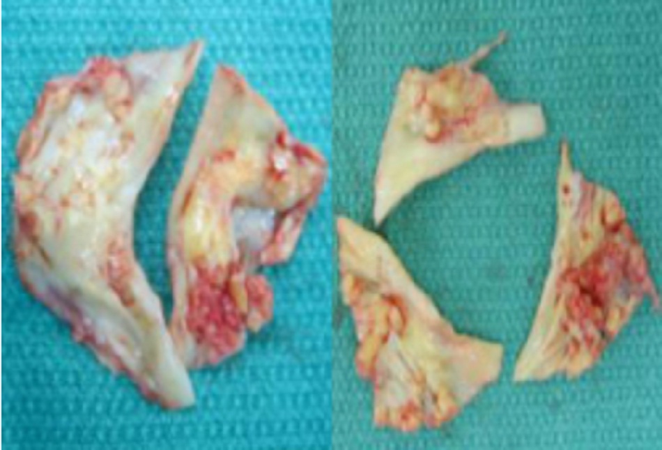Hình 1: Van động mạch chủ hai lá và ba lá bị vôi hóa nặng sau khi phẫu thuật cắt bỏ