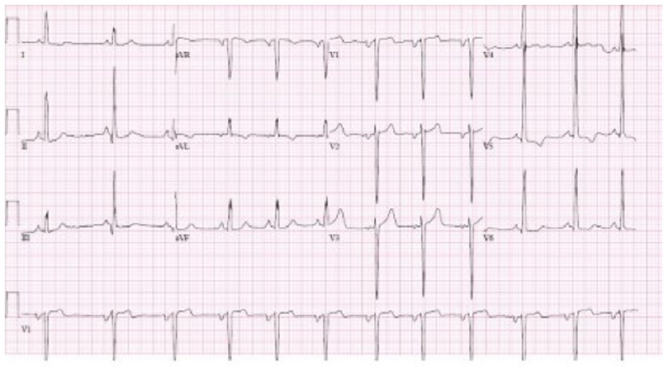 Hình 3: Điện tim cho thấy những thay đổi liên quan đến LVH