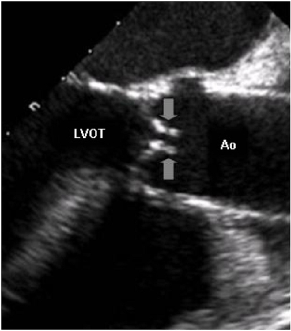 Hình 4: Siêu âm tim qua thực quản cho thấy đường ra tâm thất trái (LVOT), động mạch chủ (Ao), và lá van gần như bất động (mũi tên) của van động mạch chủ bị hẹp nặng
