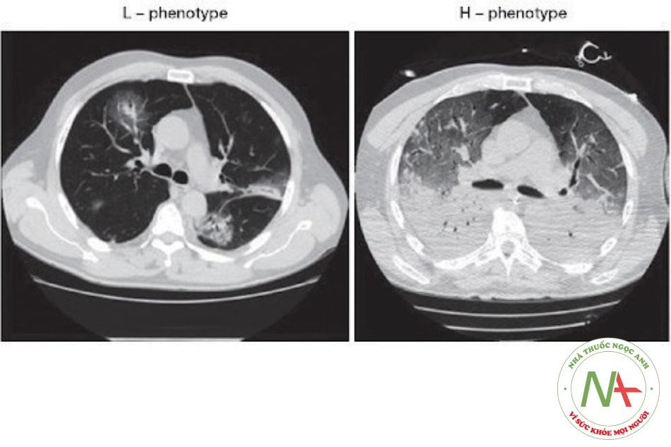 Hình 14.1. Hình ảnh tổn thương phổi (type L và type H) trên phim cắt lớp vi tính