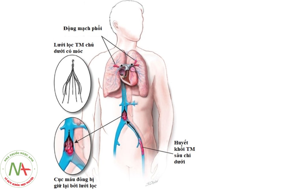 Hình 16.10. Lưới lọc tĩnh mạch chủ dưới (Nguồn: AHA Journal)