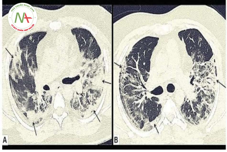 Hình 24.2. Bệnh nhân nam 45 tuổi bị di chứng viêm phổi COVID-19. CT ngực cơ bản tại thời điểm nhập viện, hình (A) cho thấy các khu vực ngoại vi bị tổn thương đông đặc (các mũi tên đen) với các tổn thương dạng kính mờ xung quanh (GGO – ground glass opacities) ở các thùy trên hai bên. Bệnh nhân bị ho dai dẳng ngay cả khi xuất viện, và theo dõi CT ngực (6 tuần sau khi xuất viện), hình (B) cho thấy hết tổn thương đông đặc ngoại vi, nhưng vẫn tồn tại vùng mô kẽ dày – xơ hóa (mũi tên đen) ở phổi hai bên.