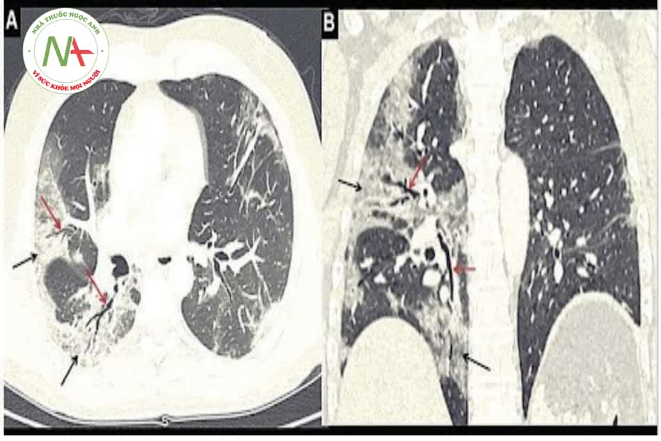 Hình 24.3. Một bệnh nhân nam 48 tuổi nhập viện vì viêm phổi COVID-19, có biểu hiện khó thở dai dẳng và mệt mỏi sau 8 tuần xuất viện. Hình ảnh chụp cắt lớp vi tính có độ phân giải cao (HRCT) dựng hình lồng ngực, trục ngang (A) và đứng (B), cho thấy các vùng ngoại vi hai bên có tổn thương dạng kính mờ (GGO) (mũi tên đen) và dày mô kẽ (phải > trái) với giãn phế quản do co kéo (mũi tên đỏ) ở thùy giữa và thùy dưới bên phải.