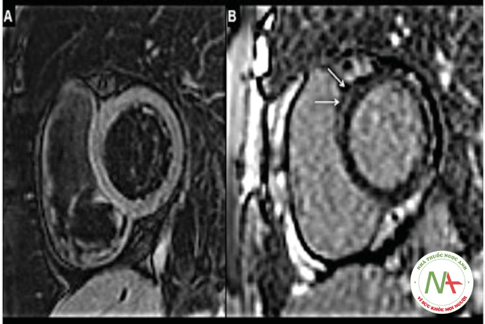Hình 24.5. MRI tim ở một bệnh nhân nữ 45 tuổi bị viêm cơ tim hậu COVID-19, vào thời điểm 5 tuần sau khi xuất viện: