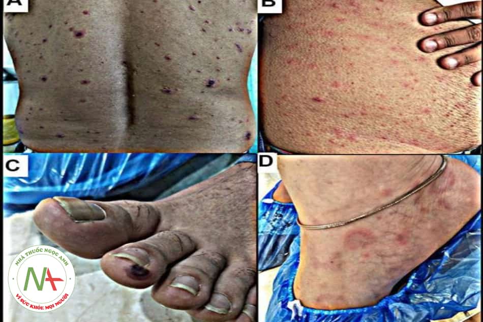 Hình 24.9. Biểu hiện da của hậu COVID-19 ở những bệnh nhân khác nhau sau thời gian chẩn đoán ban đầu khác nhau:
