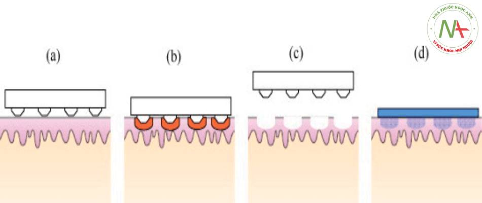 Hình ảnh dùng RF bóc tách: (a) vi điện cực được đặt vào da, (b): khi áp vào da sẽ tạo hiệu ứng nhiệt, (c), (d): khi tháo ra sẽ tạo các lỗ nhỏ tạo điều kiện thuốc thấm vào da được tốt hơn.